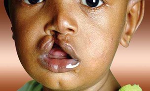 Comprehensive Cleft Care in Low and Middle Income Countries